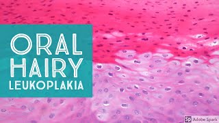 WHAT IS HAIRY LEUKOPLAKIA Oral Hairy Leukoplakia Symptoms Causes Diagnosis Treatment [upl. by Anividul]