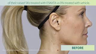 Age Spots  Seborrheic Keratosis New Treatment ESKATA  ESKATA for SKs [upl. by Trumaine]