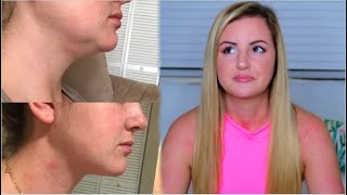 MY CHIN LIPO EXPERIENCE  COST PROCESS BEFORE amp AFTERS [upl. by Dnilasor868]