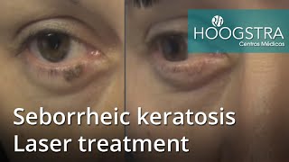 Seborrheic keratosis  Laser treatment 21021 [upl. by Sorac]