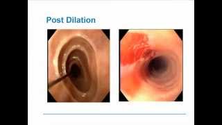 Eosinophilic Esophagitis [upl. by Heinrick]