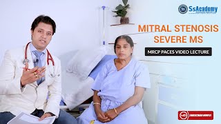 MRCP PACES Clinical Case  Cardiology  Severe Mitral Stenosis MS [upl. by Eaver]