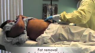 MyShape Lipo Testimonial Abdominal Liposuction Liposuction Specialist Large Volume Liposuction [upl. by Enimisaj]