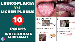 FAQ 5 What is the difference between Oral Hairy Leukoplakia and Hairy Tongue [upl. by Quintana]