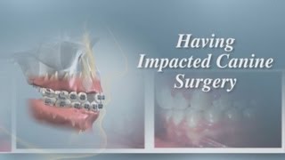 Having Impacted Canine Surgery [upl. by Elohcim]