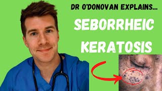 Explaining Seborrheic Keratosis  With Dr ODonovan [upl. by Yelkao202]