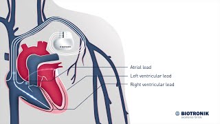 Cardiac Resynchronization Therapy – How it works [upl. by Mahala]