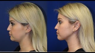 ChinNeck Liposuction Before  After  Nashville Plastic Surgeon [upl. by Meier740]