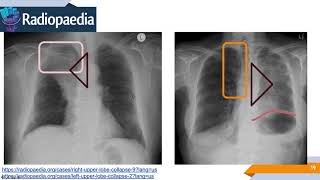 Imagenología de Tórax Signos Radiológicos [upl. by Eceinert]