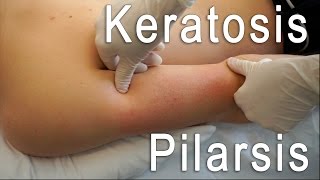 Keratosis Pilaris Clear  Brilliant Treatment FT Eric Smith  BLUSH Beverly Hills [upl. by Norri771]