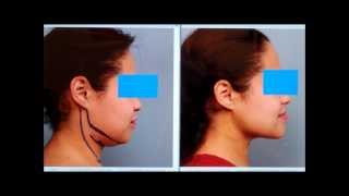 Sculpt the Chin amp Neck With Liposuction  Dr Sterry Explains [upl. by Adlev232]