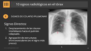 10 Signos Radiológicos en el Tórax [upl. by Janenna]