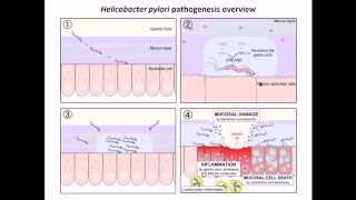 Helicobacter Pylori 101 The Bacteria That Can Cause Stomach Cancer  GUTCARE [upl. by Rabush74]