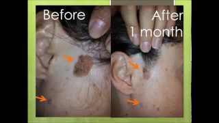 Natural treatment for seborrheic keratosis before and after photos [upl. by Yared]