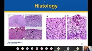 Eosinophilic Esophagitis Page [upl. by Barfuss]