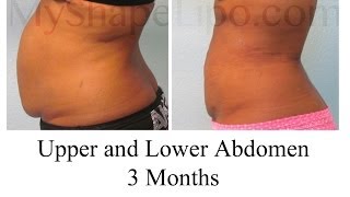 Do I Need Liposuction or Tummy tuck MyShape Lipos Trevor Schmidt PAC Reviews [upl. by Lavella]