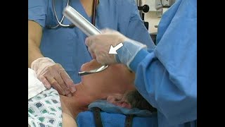 Orotracheal Intubation [upl. by Yellek]