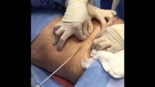 Tumescent Liposuction for Fat Removal [upl. by Huckaby]