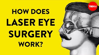 How does laser eye surgery work  Dan Reinstein [upl. by Gupta]