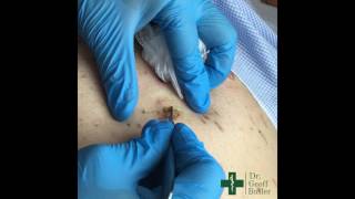 Removal of Seborrheic Keratosis [upl. by Candra980]