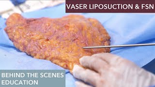 The Science Behind Vaser Liposuction How Does It Work [upl. by Girish]