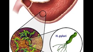 Helicobacter Pylori [upl. by Henderson]