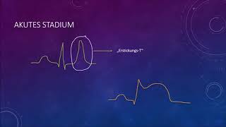EKG Crashkurs Teil 5 Herzinfarkt [upl. by Drawdesemaj]
