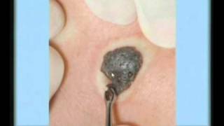 Seborrheic Keratosis Treatment [upl. by Orecic356]