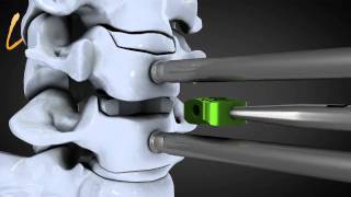 Hernie discale cervicale  Spinal disk herniation  Kisco International [upl. by Karine]