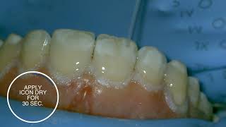 White spot treatment using infiltration with Icon  stepbystep [upl. by Lletnahs202]