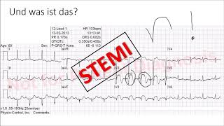 Infarkt im EKG STEMI NSTEMI Sgarbossa Kriterien Wellens Syndrom [upl. by Rist]