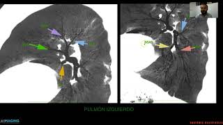 Anatomía Radiológica del Tórax [upl. by Hocker180]