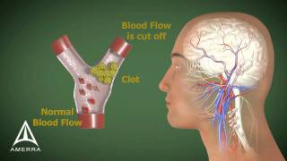 Stroke  3D Medical Animation [upl. by Humbert243]