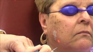 Dr Bruce Katz Treats Sun Spots with the Alexandrite Laser [upl. by Ned]