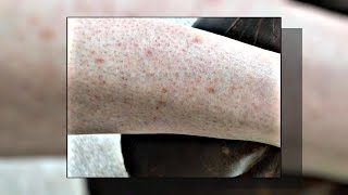 Seborrheic Keratosis What Is It amp How to Treat It [upl. by Deny81]