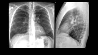 Radiografía de Tórax Evaluación Básica Inicial [upl. by Nadab]