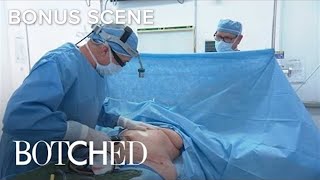 quotBotchedquot Doc Performs Liposuction Surgery  E [upl. by Eckardt854]