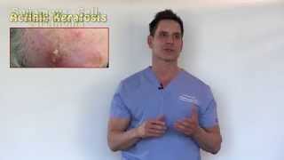 PreCancers or Actinic Keratosis Treatment Options With Dr Timothy Jochen [upl. by Pavlov]