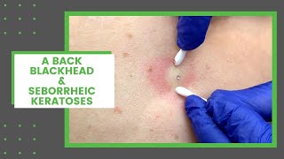 A Back Blackhead amp Seborrheic Keratoses  Dr Derm [upl. by Aidyl]