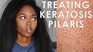 TREATING KERATOSIS PILARIS  3 EASY STEPS [upl. by Hsejar]