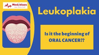 ENT 359 a Leukoplakia Keratosis Larynx PreMalignant lesion vocal cord precancerous [upl. by Quent]